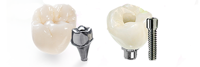 crown-and-bridge-solutions-1